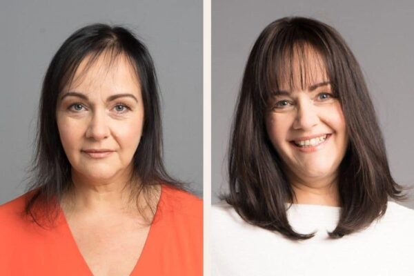 Beispiel 01 Oberkopfverdichtung mit Microlines-System